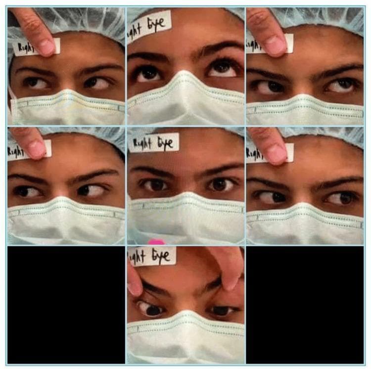 Clinical photograph showing a preoperative orthoptic assessment of a 15-year-old male. The composite image displays a 3x3 grid (with seven active frames) documenting the nine cardinal positions of gaze. The patient is wearing a surgical cap and mask, with a 'Right Eye' label on the forehead for orientation. The assessment demonstrates a limitation of elevation in the right eye, most prominent when the eye is in an adducted position (looking toward the nose and up), characteristic of Brown syndrome. Specifically, in the top-left frame (leversion and elevation), the right eye shows a failure to elevate compared to the left eye, resulting in a vertical misalignment (hypotropia). The central frame shows orthotropia in the primary position. This visual documentation supports the diagnosis of traumatic Brown syndrome involving the superior oblique tendon, illustrating the classic mechanical restriction of the inferior oblique muscle's action during adduction.