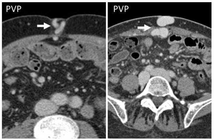 Diagnostic axial CT scans of the abdomen in the portal venous phase (PVP) from two different patients with liver cirrhosis. The images demonstrate the classic CT appearance of 'caput medusae,' characterized by prominent, tortuous, contrast-enhanced collateral vessels (indicated by white arrows) within the subcutaneous fat of the anterior abdominal wall at the level of the umbilicus. These findings result from the recanalization of the umbilical vein as a portosystemic shunt in the setting of portal hypertension. The left image shows a more slender, tortuous morphology of the umbilical collateral, while the right image displays larger, more rounded, hyperattenuating vascular cross-sections in the periumbilical region. Both images show typical abdominal anatomy, including the subcutaneous and mesenteric fat, bowel loops, abdominal wall musculature, and the lumbar vertebrae posteriorly. This visual finding is a crucial diagnostic indicator of advanced liver disease and significant portal venous pressure elevation.