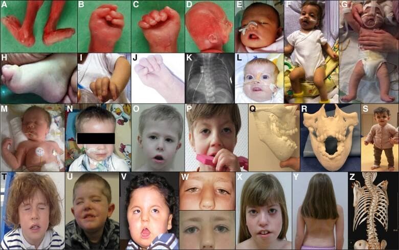 This composite clinical figure illustrates the multifaceted phenotypic spectrum of Fetal Acetylcholine Receptor Antibody-related Disorders (FARAD) across various developmental stages. Panels A–D show severe, lethal manifestations including fetal specimen arthrogryposis multiplex congenita (AMC) with rigid joint contractures of the lower limbs and characteristic clenched fists. Neonatal panels (E–G, L–N) demonstrate congenital hypotonia, bulbofacial weakness requiring nasogastric tubes, and respiratory distress. Musculoskeletal findings include clubfoot (H), limb contractures (I, J), and scoliosis (Y, Z). Advanced diagnostic imaging includes a chest radiograph (K) showing diaphragmatic paresis and 3D CT reconstructions (Q, R, Z) highlighting significant jaw contractures and spinal deformity. Longitudinal clinical photographs (O–X) track the evolution into a persistent myopathic facies in older children, characterized by ptosis, incomplete eye closure (lagophthalmos), and an inverted V-shaped mouth. The collection emphasizes the progression from neonatal bulbar and respiratory impairment to long-term neuromuscular sequelae, illustrating the educational hallmarks of transplacental maternal antibody-mediated fetal neuromuscular blockade.