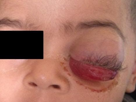 This clinical photograph displays a pediatric patient with severe unilateral ocular pathology of the right eye, characteristic of an orbital rhabdomyosarcoma. The image shows significant axial proptosis (exophthalmos), where the eyeball is markedly displaced forward from the orbit. Associated findings include severe mechanical ptosis due to the bulk of the tumor and inflammatory response. A prominent feature is the severe chemosis, with the bulbar conjunctiva appearing prolapsed, edematous, and erythematous, extending beyond the eyelid margins. The periorbital tissues show secondary signs of inflammation and irritation, with visible skin discoloration following the inferior orbital rim. The rapid progression indicated by these signs is a hallmark of pediatric orbital sarcomas. This visual serves as a critical educational example for distinguishing malignant orbital tumors from periorbital cellulitis or other inflammatory conditions in ophthalmology and pediatric oncology.