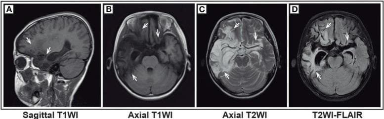 This set of diagnostic images features four brain MRI sequences of a pediatric patient, illustrating significant parenchymal abnormalities. Panel A (sagittal T1WI) and Panel B (axial T1WI) demonstrate diffuse, poorly defined regions of low signal intensity (hypointensity) localized to the bilateral frontal lobes, temporal lobes, and insula. Panel C (axial T2WI) and Panel D (axial T2-FLAIR) reveal these same anatomical regions as hyperintense (high signal), indicating widespread cortical and subcortical edema or tissue damage. The images show notable structural changes, including broadening and deepening of sulci and 'crack-like' patchy low signals in the adjacent brain tissue, suggesting atrophy or necrotic progression typical of post-viral encephalitis. The third ventricle is slightly expanded, and there is visible dilation of the right temporal horn of the lateral ventricle, though midline structures remain stable. These findings are clinically consistent with anti-NMDA receptor encephalitis secondary to Herpes Simplex Virus (HSV) encephalitis, highlighting the typical limbic and frontal involvement seen in pediatric neuro-inflammatory conditions.