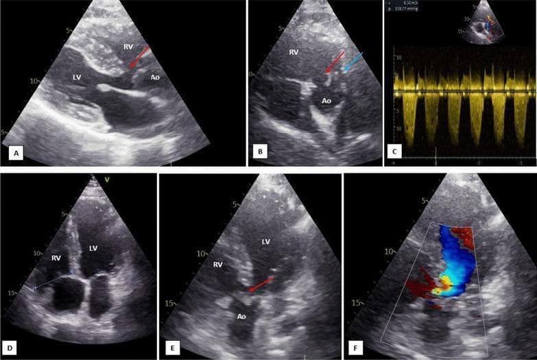 This composite of transthoracic echocardiographic (TTE) images displays key diagnostic features of Tetralogy of Fallot (TOF). The 2D grayscale images (A, B, E) identify a large malalignment-type ventricular septal defect (VSD, red arrows) and an overriding aorta (Ao) positioned over the interventricular septum. Image B, a parasternal short-axis view, further highlights a hypoplastic main pulmonary artery (blue arrow). Image D, an apical four-chamber view, shows a moderately dilated and hypertrophied right ventricle (RV) compared to the left ventricle (LV). Functional assessment via Continuous Wave Doppler (C) demonstrates severe right ventricular outflow tract (RVOT) obstruction with a peak velocity (Vmax) of 6.3 m/s, indicating a high pressure gradient. Image F uses Color Doppler to visualize bidirectional shunt flow across the VSD. This set illustrates the classic anatomical components of TOF: VSD, overriding aorta, RVOT stenosis/pulmonary hypoplasia, and subsequent RV hypertrophy, providing a comprehensive pedagogical overview of cyanotic congenital heart disease imaging.