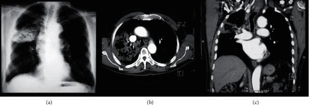 A multimodal diagnostic image set featuring a posteroposterior (PA) chest X-ray (a), an axial chest CT scan with contrast (b), and a coronal chest CT reconstruction (c) demonstrating necrotizing pneumonia. The images highlight extensive pathology in the right lung. Image (a) shows a heterogeneous opacification and lobar consolidation within the right middle or upper zone containing radiolucent lucencies. The CT images (b and c) provide high-resolution details of a dense lobar consolidation specifically in the right upper lobe, characterized by internal cavitation or ‘caverns’ representing tissue necrosis. Furthermore, the CT scans reveal significant parahilar lymphadenopathy and patchy consolidation. This comparative imaging illustrates the superior sensitivity of CT in identifying pulmonary cavitation and hilar adenopathy compared to conventional radiography. The visual evidence is consistent with fungal infections such as Histoplasma capsulatum, emphasizing clinical significance in identifying complications like necrosis and lymph node involvement in infectious pulmonary diseases.