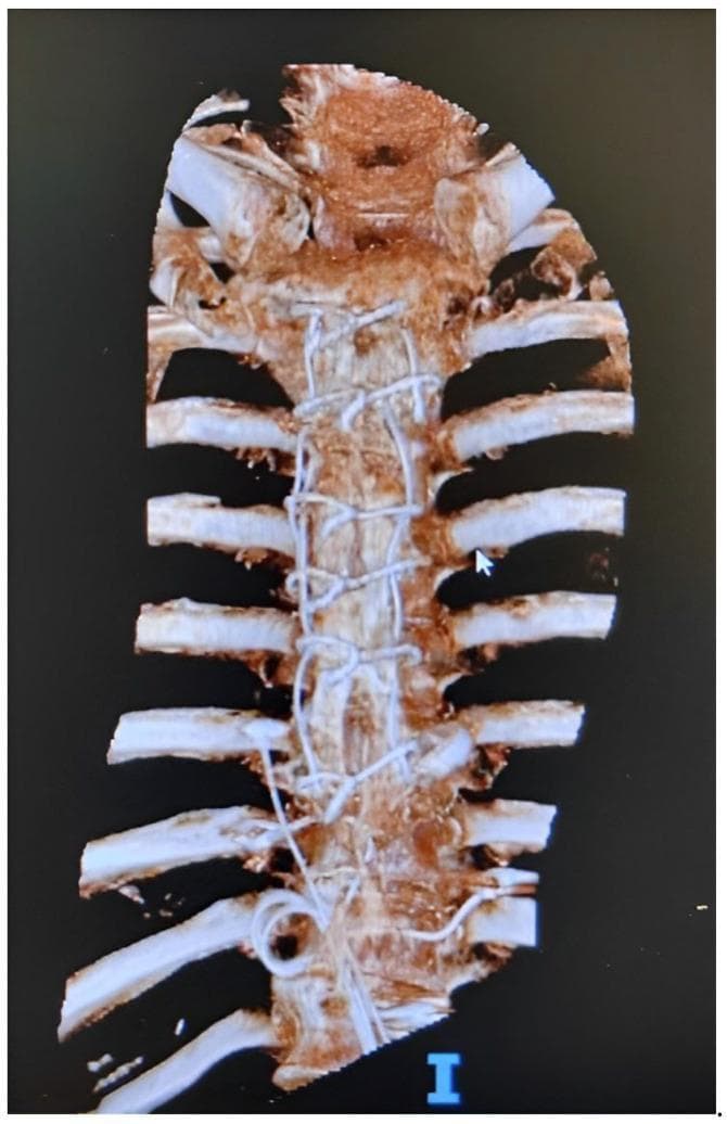 This 3D volume-rendered CT reconstruction displays the anterior thoracic cage, focusing on the sternum and costal cartilages. The primary finding is the presence of multiple radiopaque surgical wires (sternal cerclage) distributed along the midline of the sternum, from the manubrium through the body. These findings are characteristic of previous median sternotomy closure. The reconstruction clearly delineates the bony anatomy of the ribs articulating with the sternum. The visual evidence of hardware without obvious displacement suggests postoperative stabilization, though the clinical context may involve investigating complications such as sternal dehiscence or osteomyelitis. This diagnostic image is intended for educational use in thoracic surgery and radiology to illustrate surgical synthesis materials and post-sternotomy skeletal anatomy.