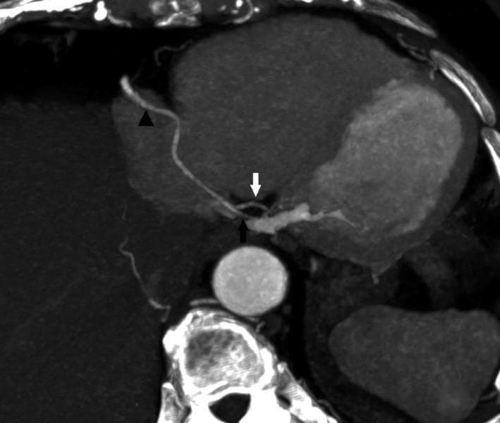 This diagnostic image is an axial slice from a Computed Tomography Coronary Angiography (CTCA) showcasing cardiac vascular anatomy. The image demonstrates right coronary dominance, a condition where the right coronary artery (RCA) supplies the posterior interventricular septum. The RCA is marked by a black triangle as it courses along the right atrioventricular groove. At the crux of the heart, the RCA is seen bifurcating into two primary terminal branches: the posterior descending artery (PDA), indicated by a white arrow, and the posterior left ventricular (PLV) branch, indicated by a black arrow. These vessels are shown in relation to the descending aorta and the cardiac chambers. This visual is significant for illustrating variations in coronary artery anatomy and dominance, specifically highlighting how the RCA compensates for territories usually supplied by the left circumflex artery in cases of right-side dominance. The image serves as a high-level educational resource for cardiology and radiology students to understand coronary branching patterns and vascular distribution.