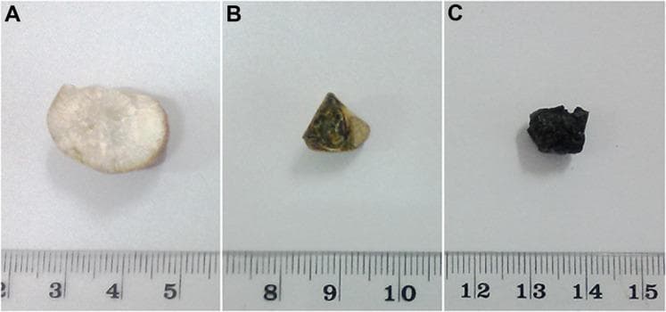 A clinical photograph displaying the cross-sectional morphology of three distinct types of human gallstones (cholelithiasis), presented with a centimeter scale for size reference. Stone A represents a pure cholesterol gallstone, characterized by a pale white color and a radially crystalline internal structure extending from the center to the periphery. Stone B depicts a mixed cholesterol gallstone, featuring a heterogeneous internal appearance with alternating light (cholesterol) and dark (pigment) concentric, crescentric layers. Stone C illustrates a pigment gallstone, showing a uniformly dark, black coloration throughout its cross-section with an irregular, rough surface texture. The image serves as an educational reference for distinguishing gallstone subtypes based on macroscopic internal and external characteristics, including color distribution, layering patterns, and crystalline arrangement.