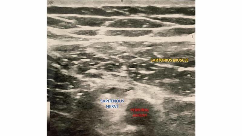 A grayscale diagnostic ultrasound image using a linear probe shows the anatomy of the subsartorial space (adductor canal) at the midthigh level. The image demonstrates three primary structures with distinct sonographic features. Superficially, the sartorius muscle is visible as a hypoechoic band with a characteristic striated fibrillar pattern. Deep to the sartorius muscle lies the femoral artery, which appears as a circular, anechoic (black) lumen indicating fluid-filled vascular content. Positioned immediately lateral to the femoral artery is the saphenous nerve, identified as a smaller, hypoechoic rounded structure with defined margins compared to the surrounding hyperechoic connective tissue and adductor musculature. This transverse view is clinically significant for regional anesthesia, specifically the adductor canal block (ACB), as it allows for the precise localization of the saphenous nerve relative to the femoral vasculature for postoperative analgesia in knee and lower extremity surgery.