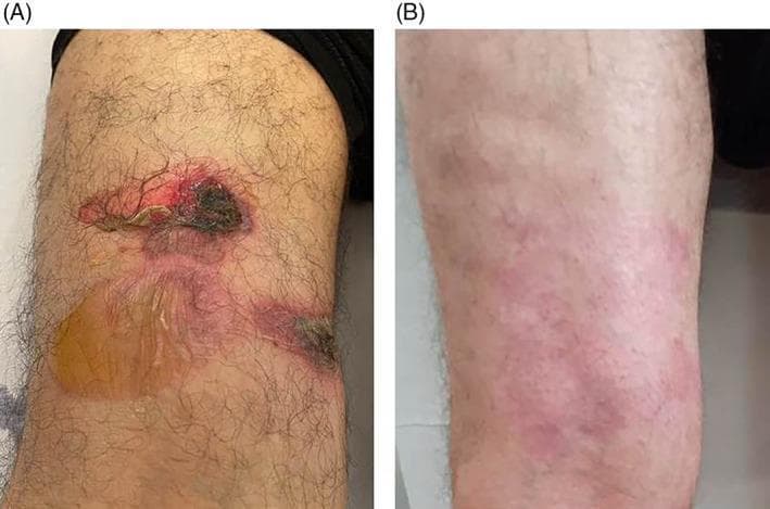A comparison chart consisting of two clinical photographs (A and B) showing the progression of bullous pemphigoid lesions on a patient's leg. Image A displays a large, tense bulla filled with serous yellowish fluid on an erythematous base. Superior and lateral to this intact blister are several irregular erosions with dark crusting and necrotic-appearing centers, indicative of ruptured bullae. The surrounding skin exhibits significant erythema and inflammation. Image B shows the same anatomical region after three weeks of corticosteroid treatment, demonstrating near-complete resolution. The previously seen blisters and erosions have cleared, leaving behind faint residual macular erythema and post-inflammatory pigmentary changes. This comparison serves as an educational tool for identifying primary autoimmune blistering diseases and monitoring clinical response to systemic therapy.