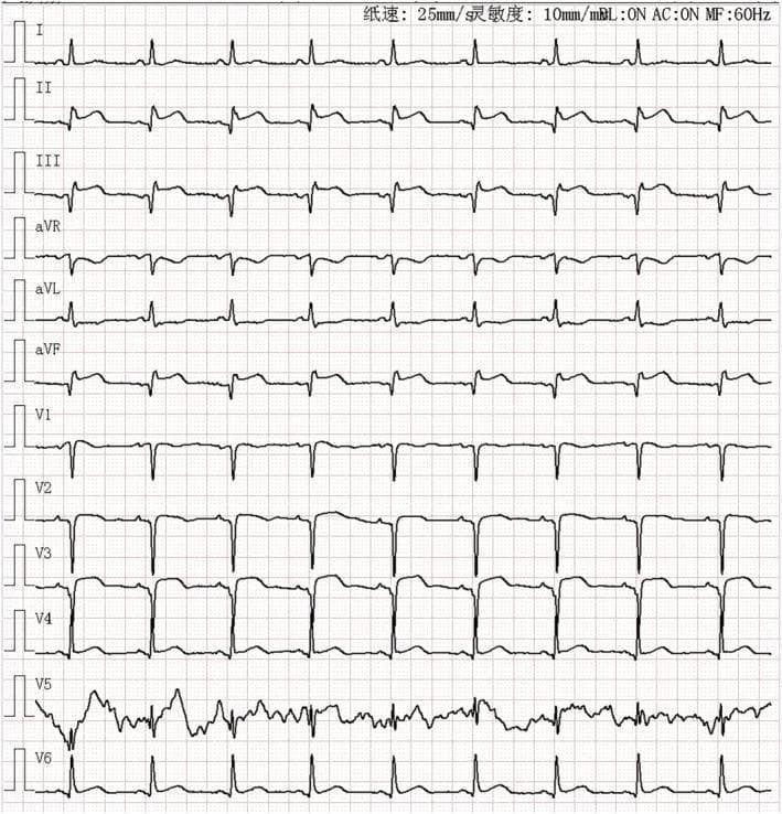 This diagnostic image is a 12-lead electrocardiogram (ECG) printed on standard grid paper (25 mm/s, 10 mm/mV). The tracing demonstrates significant ST-segment elevation in both the anterior leads (V1-V6) and the inferior leads (II, III, and aVF). In the inferior leads (II, III, aVF), pathological Q waves are clearly visible alongside the ST-segment elevation, suggesting a possible evolving or prior inferior myocardial infarction. The anterior leads, particularly V1 through V4, show prominent ST-segment elevation and developing Q waves, consistent with an acute anterior ST-elevation myocardial infarction (STEMI). Reciprocal ST-segment depression is noted in lead aVL. The rhythm appears to be sinus, though baseline artifacts are present in lead V5. This ECG illustrates extensive cardiac ischemia and injury involving multiple myocardial territories, which is clinically significant for the diagnosis of multi-vessel involvement or a proximal coronary artery occlusion.