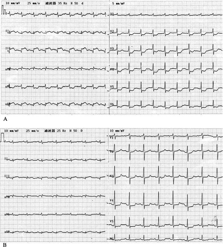 This diagnostic image consists of two 12-lead electrocardiograms (ECGs) labeled A and B, demonstrating the evolution of an acute inferior myocardial infarction (MI). Figure A shows a baseline ECG upon admission with sinus tachycardia (approximately 113 bpm). Significant findings include ST-segment elevation in the inferior leads (II, III, and aVF) accompanied by prominent pathologic Q-waves, indicative of acute transmural ischemia in the right coronary artery (RCA) territory. Reciprocal ST-segment depression is also visible in several precordial leads. Figure B displays the follow-up ECG after primary percutaneous coronary intervention (PCI). This panel demonstrates a notable attenuation of the ST-segment elevation toward the baseline and a reduction in the depth of the pathologic Q-waves, signifying successful reperfusion and resolution of the acute injury phase. The comparison illustrates the classic electrocardiographic sequence of successful intervention for an ST-elevation myocardial infarction (STEMI).
