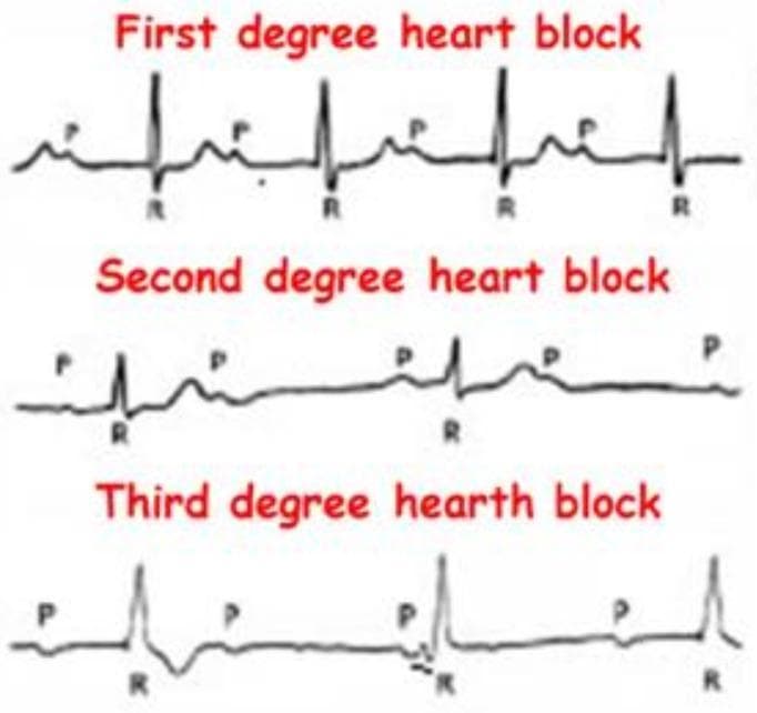 This Comparison Chart illustrates the electrocardiographic (ECG) characteristics of Atrioventricular (AV) blocks. It features three stacked rhythm strips categorized as First, Second, and Third-degree heart blocks, emphasizing the relationship between P waves (atrial depolarization) and QRS complexes (ventricular depolarization). The 'First degree heart block' panel demonstrates a consistent 1:1 P-to-QRS ratio with a fixed, prolonged PR interval. The 'Second degree heart block' panel shows intermittent conduction failure, where specific P waves are not followed by a QRS complex. The 'Third degree heart block' panel depicts complete AV dissociation, where P waves and QRS complexes occur independently and at different rates, indicating a total interruption of impulse transmission and the presence of a ventricular escape rhythm. This diagnostic illustration is designed for cardiovascular education to help students and clinicians distinguish between different stages of cardiac conduction system disease and their associated clinical significance.