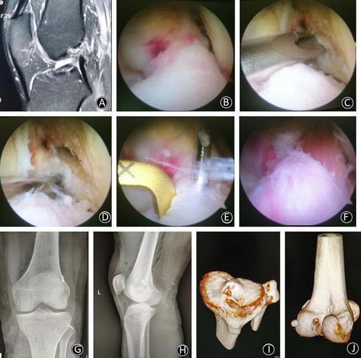 A multi-modal educational image series detailing a single-bundle anterior cruciate ligament (ACL) reconstruction procedure. Panel (A) shows a sagittal MRI of a ruptured ACL. Panels (B-F) provide an intraoperative arthroscopic sequence: (B) visualization of the ACL rupture; (C) marking the femoral I.D.E.A.L. point and positioning the Kirschner wire; (D) assessment of the femoral tunnel; (E) placement of the tibial drill guide at the remnant footprint; and (F) final graft fixation passing through the center of the ACL stump. Panels (G-H) are postoperative anteroposterior and lateral radiographs showing the hardware position, including the TightRope button. Panels (I-J) present 3D CT reconstructions demonstrating the precise anatomical entry and exit points for the tibial and femoral bone tunnels respectively. The content is designed for orthopedic surgical training, focusing on anatomical tunnel placement and the preservation of ACL remnants during reconstruction.