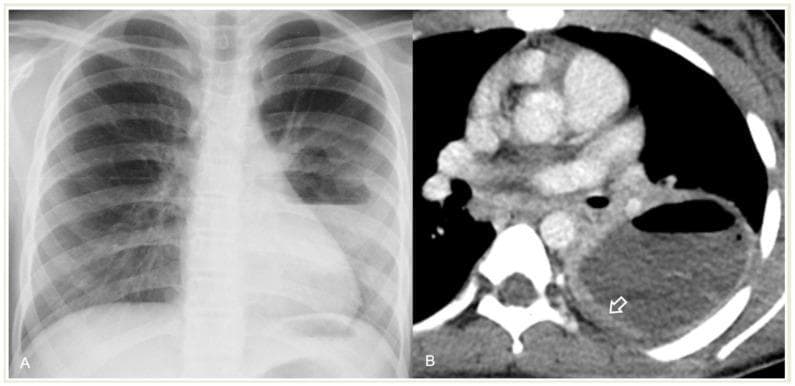 This dual-panel image displays diagnostic imaging of a 12-year-old female with a lung abscess complicating community-acquired pneumonia (CAP). Panel (A) is a frontal chest radiograph (X-ray) showing a large, well-circumscribed cavitary lesion in the right lung field. The lesion is characterized by a prominent horizontal air-fluid level, where the upper portion is radiolucent (air) and the lower portion is opaque (fluid/pus). Panel (B) is a transverse axial contrast-enhanced CT (CECT) scan of the thorax at the level of the hila. It demonstrates a large, hypodense fluid-filled cavity within the right lung parenchyma. Key features include a thick, irregular, and strongly enhancing peripheral wall (indicated by an arrow), which is a classic diagnostic sign of an abscess. The CT further confirms the presence of an air-fluid level. These findings are essential for differentiating a lung abscess from other complications like necrotizing pneumonia or loculated empyema, which typically lack such a well-defined enhancing wall.