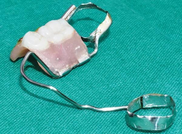 This clinical photograph displays a functional lingual arch space maintainer, specifically a Lockable Hinge-type Lingual Dentulous (LHLD) appliance, used in pediatric dentistry. The device consists of two stainless steel molar bands designed for cementation onto the mandibular first molars. A 0.9 mm stainless steel lingual arch wire connects the bands, contoured to follow the lingual anatomy of the dental arch. Integrated into the edentulous span is a dentulous component featuring two artificial white acrylic molar teeth set within a pink heat-cure or self-cure acrylic resin base, simulating natural gingival tissue. The acrylic section is attached to the lingual arch via a hinge mechanism consisting of metal molar tubes, allowing for functional movement. This appliance is indicated for pediatric patients with premature loss of primary molars to prevent space loss, maintain mesiodistal dimensions for succedaneous teeth, and restore masticatory function.