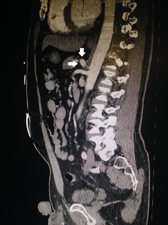 This diagnostic image is a contrast-enhanced computed tomography (CT) scan of the abdomen and pelvis in a sagittal reconstruction view. The image displays the lumbar spine posteriorly and the abdominal aorta as a hyperdense, vertically oriented vessel. A significant vascular pathology is identified at the origin of the celiac artery (ostium). White arrows indicate a focal dissection and associated pseudoaneurysm at the celiac axis. The pseudoaneurysm appears as a localized, irregular outpouching of contrast material protruding beyond the expected vessel wall boundary, with evidence of wall disruption. The superior mesenteric artery (SMA) is visible just inferior to the celiac artery origin. This imaging is critical for diagnosing mesenteric vascular emergencies and guiding conservative or surgical management in cases of isolated visceral artery dissection. The educational focus is on the radiological presentation of rare vascular abnormalities in the upper gastrointestinal arterial supply.