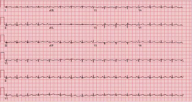 A standard 12-lead electrocardiogram (ECG) displayed on a red grid background, demonstrating a normal sinus rhythm with a heart rate of approximately 97 beats per minute. The primary diagnostic finding is generalized low voltage, characterized by QRS complex amplitudes of less than 5 mm (0.5 mV) in all limb leads (I, II, III, aVR, aVL, and aVF) and less than 10 mm (1.0 mV) across all precordial leads (V1-V6). The rhythm is regular with upright P waves in lead II and inverted P waves in aVR, each preceding a narrow QRS complex. There is subtle evidence suggesting possible left atrial enlargement. This ECG is representative of clinical conditions where electrical signal conduction to the surface electrodes is attenuated, such as large pericardial effusions or cardiac tamponade, particularly relevant in the context of post-viral inflammatory complications like COVID-19.
