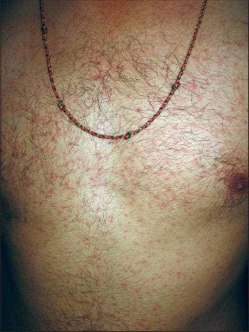 This clinical photograph shows the anterior trunk of an adult male patient demonstrating a generalized erythematous maculopapular exanthem. The skin lesions consist of numerous small, red macules and slightly elevated papules distributed symmetrically across the chest and abdomen. The rash is non-confluent in most areas, presenting as discrete spots against the background of normal skin. The anatomical region is notable for significant terminal hair growth and the presence of a decorative thread necklace. Clinically, this type of maculopapular rash is a common cutaneous finding in various systemic conditions, including viral exanthems, drug eruptions, or specific infectious diseases such as early-stage syphilis or Chikungunya fever, depending on the broader clinical context. The image serves as a teaching tool for identifying morphology and distribution patterns in dermatology and infectious disease specialties.