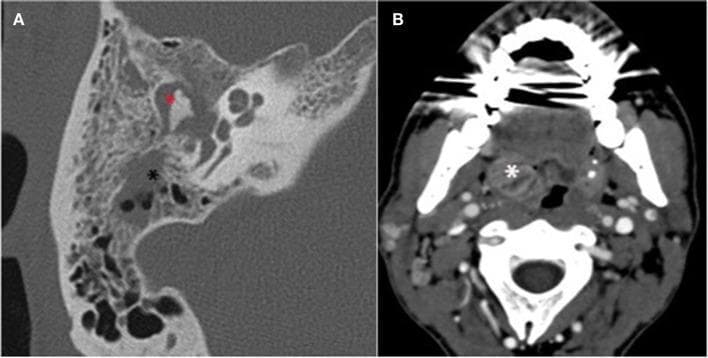This composite image presents two diagnostic CT scans. Image A is a high-resolution axial CT scan of the right temporal bone, demonstrating acute otitis media. Pathological findings include homogenous soft tissue opacity filling the middle ear (tympanic cavity) and opacification of the mastoid air cells (indicated by a black asterisk), replacing the normal hypodense air pockets. Image B is an axial soft-tissue window CT scan of the neck at the level of the oropharynx. It reveals significant asymmetric swelling and inflammation of the right palatine tonsil (marked with a white asterisk) and surrounding peritonsillar soft tissues, consistent with tonsillitis. The images illustrate the clinical complications of an upper respiratory infection extending to the middle ear and mastoid system. Key educational concepts include temporal bone anatomy, diagnostic imaging for otitis media and mastoiditis, and the identification of inflammatory neck pathology via computed tomography.