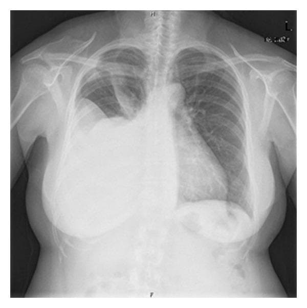 A posterior-anterior (PA) chest radiograph demonstrating a large, dense, homogeneous opacity in the right hemithorax, consistent with a massive pleural effusion. The opacity extends from the lung base to the mid-thoracic region, exhibiting a classic meniscus sign at its superior border where it meets the lateral chest wall. There is significant mass effect, evidenced by a contralateral (leftward) shift of the mediastinum and trachea. The right hemidiaphragm and costophrenic angle are completely obscured by the fluid collection. The left lung field remains relatively clear with normal pulmonary vascular markings. This diagnostic image is characteristic of a large-volume pleural effusion, requiring clinical correlation for etiologies such as malignancy (e.g., Meigs syndrome or metastatic ovarian cancer as suggested by context), heart failure, or infection.