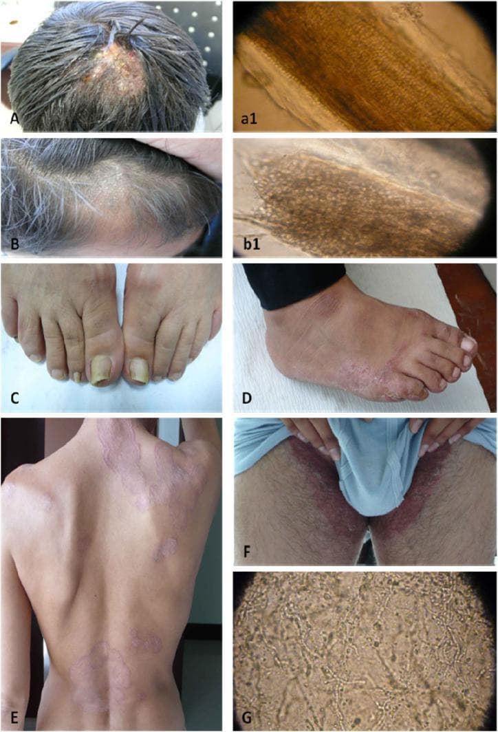 This composite educational image illustrates various clinical and microscopic manifestations of dermatophytosis. Panels A and B display Tinea Capitis: (A) demonstrates Endothrix infection with a visible patch of broken hair shafts and scalp inflammation, while (B) shows Ectothrix infection characterized by circular alopecia with fine gray scaling. Panels a1 and b1 provide corresponding microscopic views of hair shafts, illustrating fungal spores inside and outside the shaft, respectively. Panel C shows Tinea Unguium (onychomycosis) with yellowing and thickening of the toenails. Panel D illustrates Tinea Pedis (athlete's foot) presenting as erythematous scaling on the lateral foot and interdigital spaces. Panel E depicts Tinea Corporis (ringworm) on the back, showing classic annular, erythematous plaques with raised, scaly borders and central clearing. Panel F demonstrates Tinea Cruris (jock itch) with a confluent erythematous rash in the bilateral groin area. Finally, Panel G shows a high-power microscopic view of fungal hyphae and spores. This collection serves as a diagnostic reference for dermatological fungal infections across different anatomical regions.