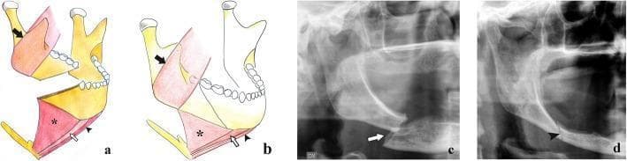 Educational composite image illustrating mandibular horizontal branch fractures, categorized by their biomechanical stability. Panels A and B are anatomical diagrams showing the interplay between fracture orientation and muscular forces. In panel A, an 'unfavorable' fracture is shown with a downward and posterior line; the masseter (black arrow) pulls the distal fragment superiorly, while the mylohyoid (asterisk), geniohyoid (white arrow), and digastric (black arrowhead) muscles pull the mesial fragment inferiorly, causing significant displacement. Panel B illustrates a 'favorable' fracture with a downward and anterior direction, where muscular forces impact the fragments together, maintaining alignment. Panels C and D provide clinical correlation via cropped panoramic radiographs of edentulous patients. Radiograph C demonstrates an unfavorable fracture with a clear step-off and misalignment (arrow). Radiograph D shows a favorable fracture where the fragments remain in contact without significant displacement (arrowhead). This content serves to teach the radiographic classification and biomechanical principles of mandibular trauma and maxillofacial surgery.