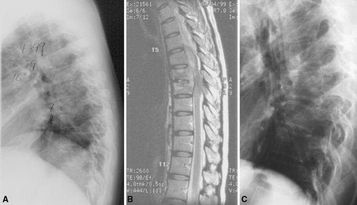 This composite diagnostic image series displays the clinical progression of thoracic spinal tuberculosis (Pott's disease) in a pregnant patient. Panel A is a baseline lateral X-ray of the thoracic spine showing vertebral body endplate irregularity and mild narrowing of intervertebral disc spaces, particularly around levels T6-T9. Panel B is a sagittal T2-weighted MRI at presentation, illustrating marrow edema, disc space involvement, and early inflammatory changes. Panel C is a follow-up lateral X-ray taken one year after a successful course of anti-tuberculous chemotherapy. It demonstrates spontaneous bony fusion of the affected vertebrae, characterized by the complete loss of intervertebral disc spaces and the development of a localized angular kyphosis. The series highlights the natural history of spinal TB where medical management leads to stabilization via auto-fusion, while also documenting the resultant structural deformity common in healed tuberculous spondylitis.