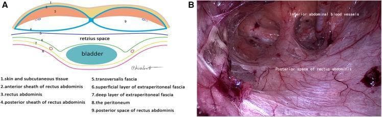 The visual is a two-part educational material focused on the surgical anatomy of the abdominal wall and preperitoneal spaces. Panel A is a cross-sectional anatomical diagram illustrating the layers of the lower abdominal wall below the arcuate line. It identifies several numbered structures: skin/subcutaneous tissue (1), anterior rectus sheath (2), rectus abdominis muscle (3), posterior rectus sheath (4), transversalis fascia (5), and extraperitoneal fascia layers (6-7) overlying the peritoneum (8) and bladder. It clearly delineates the Retzius space and the posterior space of the rectus abdominis (9). Panel B is a laparoscopic still-frame of the posterior space of the rectus abdominis during a surgical procedure (likely TEP inguinal hernia repair). The image shows the reddish-pink, striated fibers of the rectus abdominis muscle and the moist, glistening texture of the posterior sheath. Labels identify the 'posterior space of rectus abdominis' and 'inferior abdominal blood vessels,' demonstrating the vascular supply and the surgical plane necessary for safe dissection above the transversalis fascia.