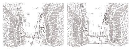 Anatomical diagram in a cross-sectional view illustrating the Transanal Hemorrhoidal Dearterialization (THD) with mucopexy procedure. The schematic is divided into two parts showing the progression of the surgical technique within the rectum and anal canal. The left side depicts a longitudinal continuous suture line being applied to the rectal mucosa and submucosa, targeting a prolapsed hemorrhoidal pile. The suture starts approximately 4-5 cm above the anal verge. The right side illustrates the effect of tying the suture, showing the clinical result where the redundant rectal tissue is plicated and lifted proximally (mucopexy), reducing the prolapse and repositioning the tissue within the distal rectum. Key anatomical features visible include the internal and external anal sphincters, the dentate line, and the rectal wall layers. This diagram serves as a surgical guide for colorectal residents and surgeons to visualize the lifting of pathologic piles during hemorrhoidal dearterialization.