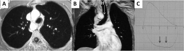 This composite educational image features thoracic MRI scans and a pulmonary function test plot demonstrating a Right-Sided Aortic Arch (RSAA) with associated tracheal compression. Panels A and B are thoracic MRI images: Panel A (axial view) shows the aortic arch positioned to the right of the trachea rather than the typical left. Panel B (coronal view) highlights significant narrowing of the tracheal air column (marked with 'H' and an arrow) caused by extrinsic compression from the RSAA. Panel C is a spirometry flow-volume loop. The expiratory limb (upper curve) shows a relatively preserved peak, but the inspiratory limb (lower curve) demonstrates a characteristic flattening or plateau (indicated by vertical arrows). This visual pattern is a diagnostic hallmark of a variable extrathoracic or fixed intrathoracic upper airway obstruction. The set serves to correlate anatomical cardiovascular anomalies with functional respiratory physiological impairments, illustrating how vascular rings or arches can lead to symptomatic tracheal stenosis.