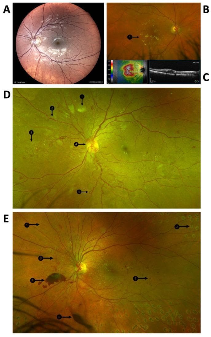 A multi-panel medical image illustrating the clinical manifestations and progression of diabetic retinopathy using fundus photography and Optical Coherence Tomography (OCT). Panel A displays a color fundus photograph of the posterior pole showing microaneurysms and dot hemorrhages indicative of diabetic maculopathy. Panel B highlights clinically significant macular edema (CSME) with visible hard exudates (B1). Panel C provides corresponding OCT imaging, including a retinal thickness heat map and a cross-sectional scan showing intraretinal fluid. Panels D and E are widefield fundus photographs demonstrating advanced proliferative diabetic retinopathy (PDR). Key pathological features identified with numbered arrows include cotton wool spots (D1), venous beading (D2), intraretinal microvascular abnormalities (IRMA) (D3/E1), neovascularization at the disc (D4), and venous loops (D5). Panel E further illustrates end-stage complications and treatment, showing laser photocoagulation scars (E2), retinal neovascularization (E3), pre-retinal hemorrhage (E4), blot hemorrhage (E5), and vitreous hemorrhage (E6). This compilation serves as an educational tool for identifying the transition from non-proliferative to proliferative diabetic disease.