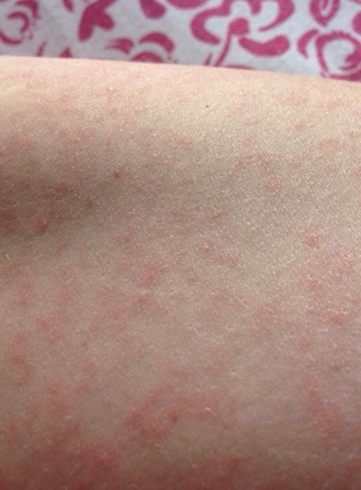A close-up clinical photograph of a maculopapular rash on a patient's arm, secondary to Zika virus infection. The image demonstrates a widespread, morbilliform eruption characterized by numerous small, erythematous macules (flat spots) and papules (raised bumps) that are pink to red in color. The lesions are densely distributed across the skin surface, showing occasional coalescence. The background skin appears otherwise normal without significant scaling or ulceration. This visual presentation is characteristic of the exanthematous phase of various arboviral infections, including Zika, dengue, and chikungunya. The image serves as an educational example of acute viral exanthema in infectious disease and dermatology contexts, illustrating the typical morphology used for clinical diagnosis in returning travelers presenting with fever and systemic symptoms.