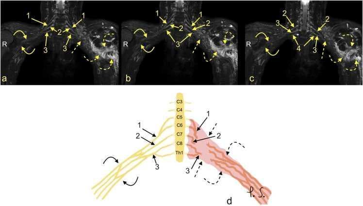 This composite educational resource comprises three Magnetic Resonance Neurography (MRN) coronal views (a, b, c) and a correlating schematic anatomical diagram (d) illustrating a severe traumatic brachial plexus injury. The right side of the images displays normal brachial plexus anatomy, with continuous nerve structures including the upper trunk (1), middle trunk (2), C8 root (3), and Th1 root (4). In contrast, the left side demonstrates a total rupture of the brachial plexus (dashed arrows). This injury is characterized by the complete discontinuity of the neural trunks and cords, accompanied by a large axillary cavity hematoma (curved dashed arrows). The schematic (d) highlights the side-to-side difference, showing the organized right-sided roots (C5-Th1) and trunks versus the disorganized, hemorrhagic area on the left. This material is designed for advanced medical education in radiology and neurosurgery, focusing on diagnostic imaging features of high-grade nerve trauma, specifically Seddon grade 3-5 injuries (neurotmesis) and the identification of postganglionic plexopathy.