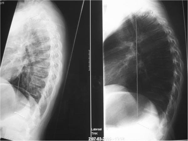 This diagnostic image consists of two side-by-side lateral X-ray radiographs of the thoracic spine in a pediatric patient, demonstrating the impact of posture on spinal sagittal alignment. The left radiograph displays the spine in an 'active sitting' posture, with a measured thoracic kyphosis angle (T1–T12) of 49 degrees. The right radiograph displays a 'relaxed sitting' posture, showing a marked increase in the kyphotic curve to 69 degrees. This exaggerated curvature, sometimes clinically referred to as 'Sitzbuckel' or 'gameboy back,' illustrates the postural flexibility and the potential for anterior compressive forces on the vertebral bodies and intervertebral discs. The images highlight the clinical importance of sagittal balance and the mechanical influences on spinal development, particularly in the context of adolescent postural kyphosis or early Scheuermann's disease. Key educational features include the measurement of Cobb angles to quantify kyphosis and the visual demonstration of how functional positioning alters the alignment of the thoracic vertebrae and associated soft tissue structures.