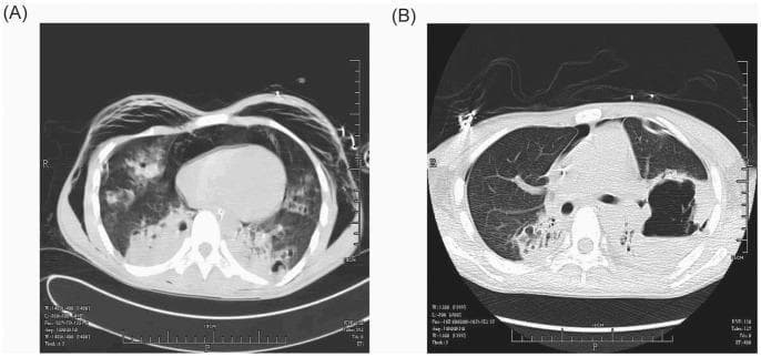 This side-by-side comparison displays axial chest computed tomography (CT) scans of a patient with necrotizing pneumonia, illustrating disease progression from day 7 (A) to day 26 (B) of hospitalization. Image A reveals bilateral, patchy alveolo-interstitial infiltrates with multiple small, low-density cavitations in the left lung consistent with early abscess formation. Additionally, there is evidence of subcutaneous emphysema and a small pneumothorax. Image B shows significant evolution of the pathology; the multiple small cavitations in the left lung have coalesced into a single, large, thick-walled abscess cavity. This mature abscess demonstrates a prominent air-fluid level, a classic radiological sign of a lung abscess containing both gas and inflammatory liquid. The surrounding lung parenchyma remains significantly compromised. These images serve as a teaching tool for recognizing the radiological stages of MRSA-related pulmonary destruction, from initial cavitation and septic complications to the formation of organized abscesses with air-fluid levels.