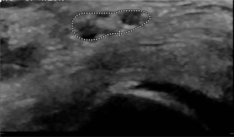 This diagnostic image is a B-mode musculoskeletal ultrasound showing a short-axis (transverse) view of the common fibular nerve (common peroneal nerve) at the level of the fibular head. The nerve is captured in a cross-sectional view and is outlined by a white dotted line for measurement of the Cross-Sectional Area (CSA). Visually, the nerve appears as an oblong, predominantly hypoechoic structure with a characteristic fascicular 'honeycomb' internal texture. A central crosshair marker indicates the site of measurement. The surrounding musculoskeletal tissue is relatively more hyperechoic, providing contrast to the nerve bundle. This imaging modality is typically used in clinical neurology or physical medicine and rehabilitation to evaluate for peripheral nerve entrapment, compression neuropathies, or traumatic injuries. The educational focus is on identifying anatomical landmarks and performing sonographic morphometric analysis of peripheral nerves in the lower extremity.