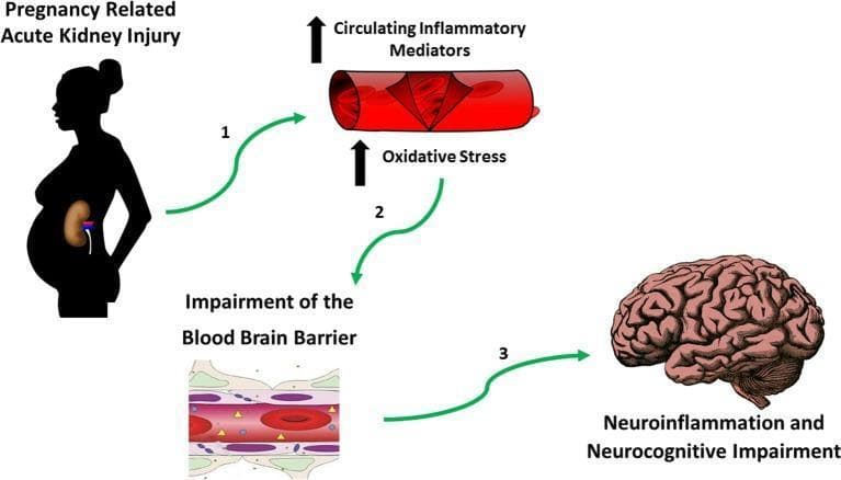 A pathophysiology diagram illustrating the hypothesized mechanistic link between Pregnancy-Related Acute Kidney Injury (PR-AKI) and long-term neurocognitive impairment. The flowchart follows a three-step sequence: (1) Initial PR-AKI, represented by a silhouette of a pregnant person with an highlighted kidney, leads to an increase in systemic circulating inflammatory mediators and oxidative stress, shown as a blood vessel cross-section with upward-trending arrows. (2) These systemic changes result in the impairment of the blood-brain barrier (BBB). A microscopic illustration of the BBB shows disrupted tight junctions and increased permeability, indicated by yellow triangular symbols passing through the endothelial lining into the neural tissue. (3) This compromised barrier facilitates neuroinflammation, which is depicted leading to the final stage: a human brain labeled with neurocognitive impairment. This diagram serves as a conceptual model for understanding the extra-renal complications of obstetric kidney disease and its potential impact on maternal brain health postpartum.