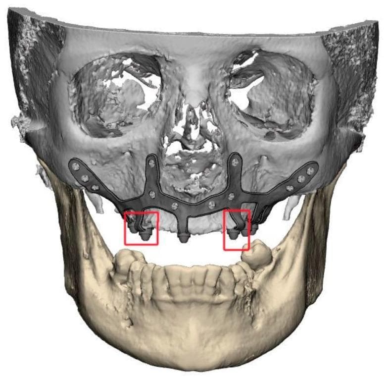 This diagnostic image features a 3D medical reconstruction of a human skull, specifically showcasing a Customized Subperiosteal Implant (CSI) applied to an atrophic maxilla. The image demonstrates a dark gray, frame-like metallic structure that is anatomically contoured to the bone surface. Key educational features highlighted include the smooth, rounded transitions between the primary implant frame and the prosthetic connection points, which are encased in red boxes for emphasis. The design lacks sharp angles and exhibits a polished surface texture, which is clinically significant for minimizing soft tissue irritation, reducing the risk of postoperative dehiscence, and preventing biofilm adhesion. Multiple fixation points are visible along the zygomatic and alveolar regions, secured with bone screws. This visual serves as a textbook example of patient-specific implant design in oral and maxillofacial surgery, particularly for complex dental rehabilitation where conventional endosseous implants are contraindicated due to severe bone resorption.