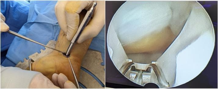 A composite image illustrating a minimally invasive endoscopic carpal tunnel release (ECTR) procedure. The left panel shows the external surgical setup: a patient's hand is positioned on a metallic hand table with blue sterile draping. A small transverse incision is visible at the proximal wrist crease, through which an endoscope and a specialized blade assembly are inserted. A surgeon's gloved hand is seen manipulating the instrumentation. The right panel displays the concurrent internal endoscopic view (endoview) within the carpal tunnel. The image highlights the dense, white, fibrous transverse carpal ligament (flexor retinaculum) and the positioning of the metallic blade and scope sheath underneath it. This visual demonstrates the surgical technique used to transect the ligament and decompress the median nerve, typically indicated for severe carpal tunnel syndrome. The procedure is categorized under orthopedic or hand surgery, focusing on compressive neuropathy management.