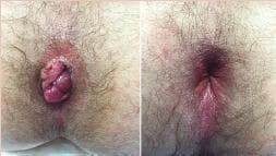 This comparison clinical photograph illustrates a pre-operative and post-operative view of the anal region in a patient with symptomatic internal hemorrhoids. The left panel shows significant internal hemorrhoidal prolapse, characterized by several engorged, reddish, and lobulated mucosal masses protruding through the anal sphincter. The tissue appears swollen with visible folds and irregular surface texture. The right panel displays the clinical outcome following Transanal Hemorrhoidal Dearterialization (THD) and mucopexy. In this view, the prolapsed hemorrhoidal tissue has been successfully reduced and lifted back into the distal rectum. The anal opening appears anatomically normal with no visible protrusions, though there is mild residual erythema of the surrounding perianal skin. This side-by-side comparison demonstrates the effectiveness of the mucopexy technique in restoring the normal anatomy of the anal canal by lifting and repositioning pathological hemorrhoidal piles.