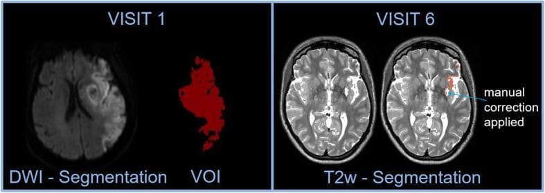 This diagnostic imaging panel demonstrates the longitudinal assessment of ischaemic stroke infarct volume via MRI. The left section (Visit 1) features a Diffusion-Weighted Imaging (DWI) axial brain scan showing a hyperintense (bright) lesion in the right hemisphere, indicative of acute infarction. Adjacent to the scan is the 'VOI' (Volume of Interest), a red binary mask representing the manual segmentation of the infarct area. The right section (Visit 6, day 90) displays T2-weighted (T2w) MRI scans. The primary scan shows the evolved hyperintense lesion, and the paired 'T2w - Segmentation' image illustrates the refined lesion boundary. An annotation indicates 'manual correction applied,' highlighting the process of adjusting the automated segmentation mask to accurately fit the T2w hyperintensity. This comparison is used in clinical research to quantify changes in lesion volume and assess treatment efficacy, such as adaptive servo-ventilation (ASV) in stroke patients with sleep-disordered breathing.