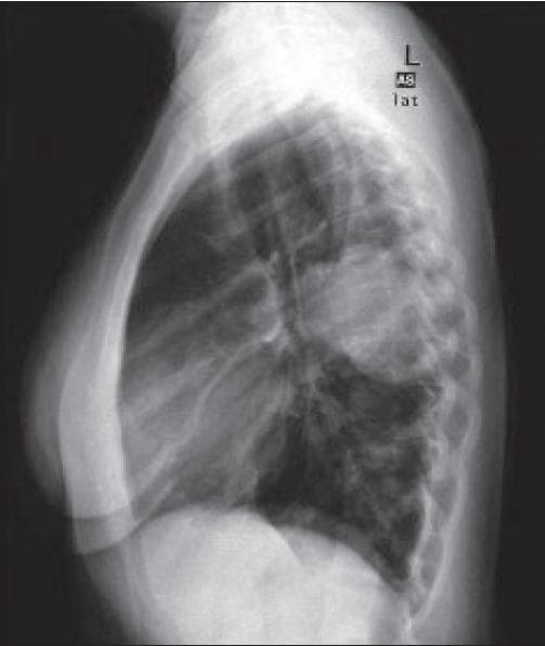 A lateral view chest radiograph (CXR) demonstrating the thoracic anatomy in profile. The imaging modality displays the sternum anteriorly as a vertically oriented, radio-opaque structure, with the thoracic spine and vertebral bodies visible posteriorly. The ribs are visualized as curved, superimposed radio-opaque bands extending from the posterior vertebrae toward the anterior chest wall with a typical slight upward slope. Centrally, the cardiac silhouette and hilar regions are visible, with pulmonary vasculature appearing as branching linear opacities. The lung fields are generally radiolucent, showing clear parenchyma without evidence of gross consolidation, masses, or pleural effusions. Key landmarks such as the retrosternal and retrocardiac spaces appear clear, and the diaphragmatic contours are visible inferiorly. This diagnostic image is representative of standard thoracic imaging for assessing pulmonary, cardiac, and musculoskeletal health in a clinical context.