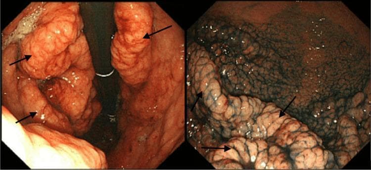 This dual-panel diagnostic image presents endoscopic views of the stomach illustrating classic features of Ménétrier disease. The left-hand panel shows a standard white-light endoscopy of the gastric body, revealing massive, convoluted, and thickened gastric rugae (marked by black arrows) that resemble cerebral gyri. These folds are hyperplastic with a reddish-pink mucosal surface. The right-hand panel demonstrates the same anatomical region using blue dye chromoendoscopy. The application of the dye enhances the surface architecture by pooling in the mucosal crevices, highlighting a reticular or 'net-like' pattern and emphasizing the irregular, bosselated texture of the hypertrophied folds. This side-by-side comparison illustrates the utility of chromoendoscopy in delineating mucosal topography for the evaluation of hypertrophic gastropathy and foveolar hyperplasia. Target audience: medical students and gastroenterology specialists.