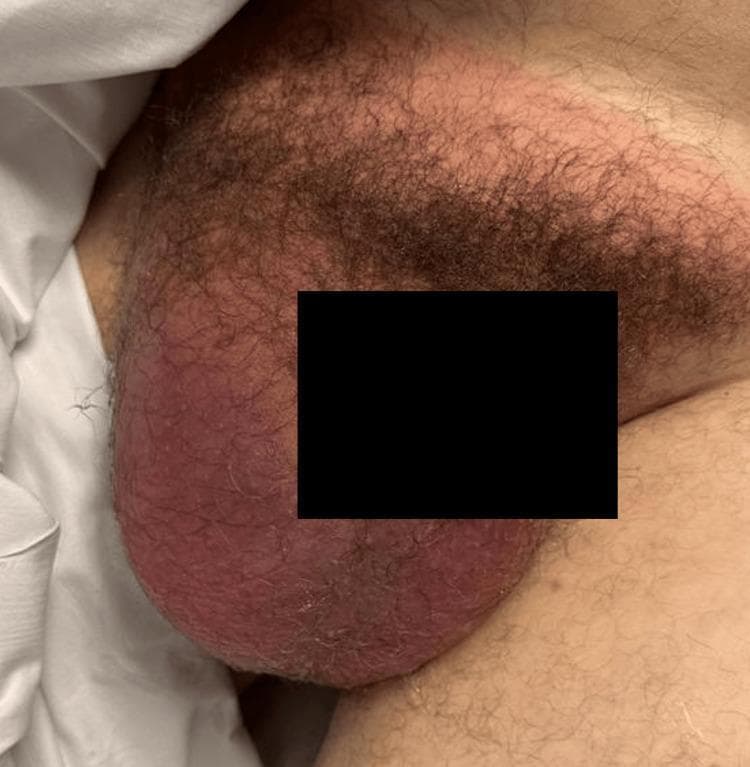 Clinical photograph of the male pelvic and groin region depicting a large, right-sided indirect inguinal hernia with scrotal extension. The image shows a significant, asymmetrical protrusion originating from the lower right inguinal area, descending deeply into the scrotum, causing marked distension and displacement of scrotal anatomy. The overlying skin exhibits diffuse, intense erythema and localized edema, suggesting an acute inflammatory or vascular process. These visual features are consistent with a strangulated or incarcerated inguinal hernia, where compromising of the blood supply to the herniated contents (such as small bowel or colon) and secondary ischemia of the scrotal structures, including the testicle, may occur. The presentation illustrates a surgical emergency requiring immediate diagnostic evaluation and operative intervention. This clinical image is intended for educational use in general surgery, emergency medicine, and urology to demonstrate the physical examination findings of complicated hernias.