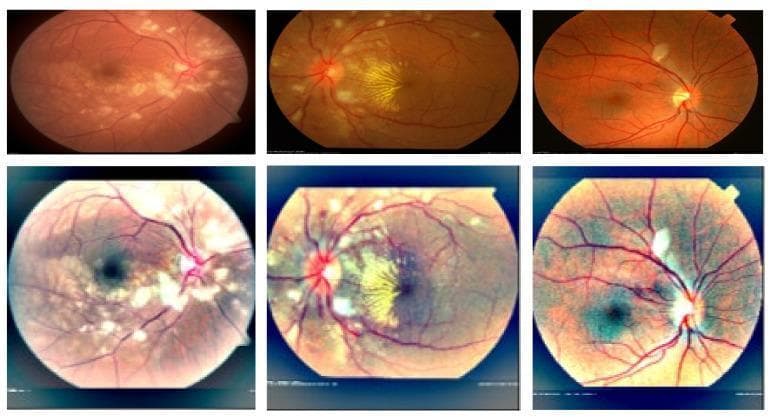 This Comparison Chart displays two rows of diagnostic retinal fundus images (retinographs) illustrating a pre-processing step for clinical imaging enhancement. The top row consists of original fundus photographs exhibiting clinical signs of malignant hypertensive retinopathy, characterized by scattered cotton-wool spots (whitish, irregularly shaped lesions), macular stars (yellowish exudates in a radial pattern), and arteriolar changes. These original images demonstrate lower contrast and muted color balance, which can obscure subtle pathological features. The bottom row presents the same images after light adjustment and contrast enhancement in a perceptual-oriented color space. These enhanced versions show significantly improved clarity of retinal structures, including sharper delineation of the retinal vasculature, the optic disc, and the boundaries of cotton-wool spots. This visual comparison highlights the educational concept of digital image processing in ophthalmology to improve the diagnostic visibility of hypertensive retinopathy features such as microvascular disorders and inflammatory exudates.