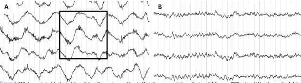 This diagnostic image displays a comparison chart of two electroencephalogram (EEG) traces, labeled A and B, demonstrating a characteristic neurologic finding and its subsequent resolution. Panel A illustrates the 'extreme delta brush' (EDB) pattern, a pathognomonic sign often associated with anti-NMDA receptor encephalitis. The waveform in Panel A is characterized by high-amplitude, rhythmic delta activity (1–3 Hz) with superimposed bursts of fast, rhythmic beta activity (20–30 Hz) appearing on the peaks or troughs of the delta waves, highlighted within a black bounding box. Panel B shows a follow-up EEG from the same patient after the initiation of immunotherapy. This trace demonstrates significant normalization, displaying rhythmic alpha frequency activity (8–13 Hz) with a smoother, more sinusoidal morphology and reduced amplitude compared to the delta-heavy waveforms in the initial study. This comparison is used in clinical education to identify specific biomarkers of autoimmune encephalitis and to monitor treatment response.