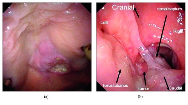 Clinical endoscopic views of a palatal squamous cell carcinoma. Image (a) shows an oral view of the tumor on the palate, presenting as a pinkish-red, irregular mass with an uneven texture and a central ulcerated area containing yellowish exudate. Image (b) provides a posterior nasal aperture view obtained via retrograde fiberscopy. This view demonstrates the tumor's superior extension into the left posterior nasal meatus with direct invasion and distortion of the nasal septum. Key anatomical landmarks are labeled, including the cranial-caudal orientation and the right torus tubarius, which appears unaffected. The tumor in the nasal cavity has a glistening, translucent, and irregular surface. This visual documentation illustrates a Stage T4b tumor, highlighting the clinical significance of assessing both oral and nasal involvement in advanced oropharyngeal and sinonasal malignancies.