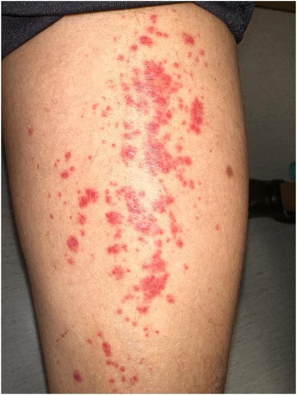This clinical photograph displays a dermatological presentation of palpable purpura on the lower extremity. The lesions are characterized by numerous erythematous to violaceous macules and small papules that range from pinpoint petechiae to larger confluent patches. These non-blanching lesions exhibit irregular borders and a scattered distribution, primarily concentrated along the pretibial area. The morphology and coloring are consistent with blood extravasation into the dermis. This visual presentation is a hallmark clinical sign of small-vessel vasculitis, specifically leukocytoclastic vasculitis. The image serves as a diagnostic educational resource for identifying inflammatory vascular skin disorders and drug-induced cutaneous eruptions in a clinical setting.