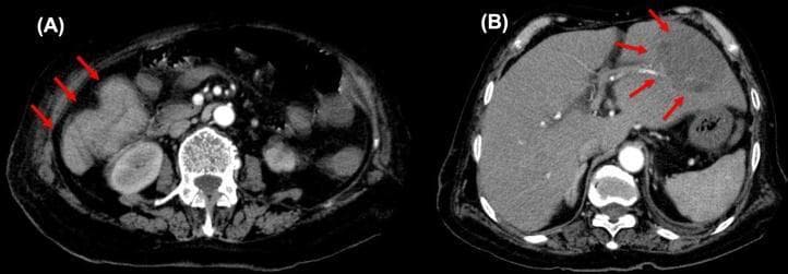 Two-panel axial contrast-enhanced CT scan of the abdomen demonstrating primary colonic malignancy and a secondary hepatic complication. Image (A) shows a transverse colon tumor in the right abdominal region, indicated by red arrows. The mass displays circumferential wall thickening, heterogeneous contrast enhancement, and irregular borders, suggestive of adenocarcinoma. Image (B) shows a large, complex liver abscess within the right hepatic lobe, highlighted by red arrows. The abscess presents as a multiloculated, low-attenuation fluid collection with peripheral rim enhancement and internal septations, characteristic of a pyogenic liver abscess. The surrounding hepatic parenchyma exhibits subtle inflammatory changes. These diagnostic images illustrate the clinical association between obstructive or perforated colorectal cancer and the development of pyogenic liver abscesses, often caused by portal venous seeding of enteric flora like Klebsiella pneumoniae. This visual material is suitable for teaching diagnostic radiology of the gastrointestinal system and hepatobiliary complications of malignancy.