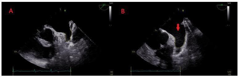 This diagnostic image consists of two side-by-side transesophageal echocardiograms (TEE) labeled A and B, demonstrating the presence of spontaneous echo contrast in the left atrium. Image A shows a baseline TEE of the left atrium and left atrial appendage with a clear, anechoic blood pool, indicating the absence of spontaneous echo contrast (SEC). Image B displays the same anatomical region but reveals visible Left Atrial Spontaneous Echo Contrast (LASEC), also known as 'smoke.' This finding is highlighted by a red arrow pointing to the faint, swirling, echogenic material within the left atrial cavity. The presence of LASEC is a critical clinical finding in patients with atrial fibrillation, as it indicates blood stasis and an increased risk for thrombus formation and thromboembolic events. The images include technical annotations such as imaging plane angles (0 and 44 degrees) and heart rate indicators at the bottom.