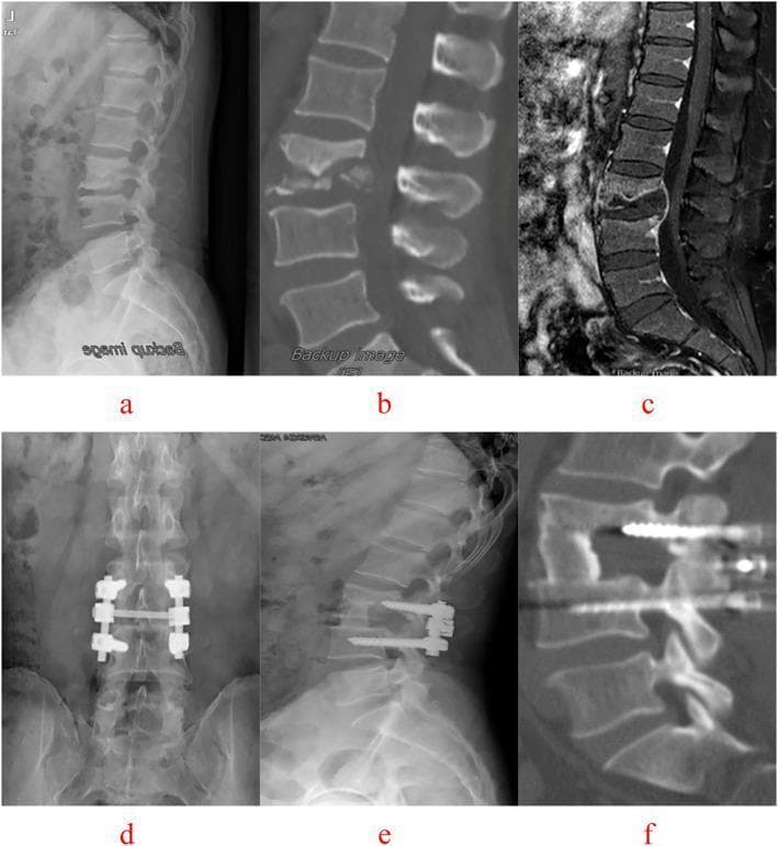 This composite of diagnostic imaging illustrates the preoperative state and postoperative outcome of lumbar spine tuberculosis (Pott's disease) at the L3-L4 level in a 47-year-old male. The top row (a-c) displays preoperative findings: (a) lateral X-ray showing collapsed intervertebral space; (b) sagittal CT reconstruction revealing significant osseous destruction of the L3-L4 vertebral bodies; and (c) T2-weighted sagittal MRI demonstrating an epidural abscess and disc space destruction causing spinal cord/nerve root compression. The bottom row (d-f) shows the 64-month postoperative status: (d) anteroposterior and (e) lateral X-rays visualize a diseased intervertebral (single-segment) fixation involving short pedicle screws and connecting rods at the L3-L4 level. (f) Sagittal CT reconstruction confirms successful interbody bone graft fusion, resolution of the tuberculous lesion, and maintenance of spinal alignment without significant loss of the correction angle. The case highlights the surgical management of spinal tuberculosis through lesion debridement, internal fixation, and fusion.